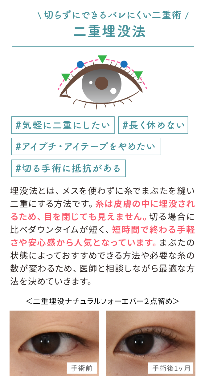 二重埋没法