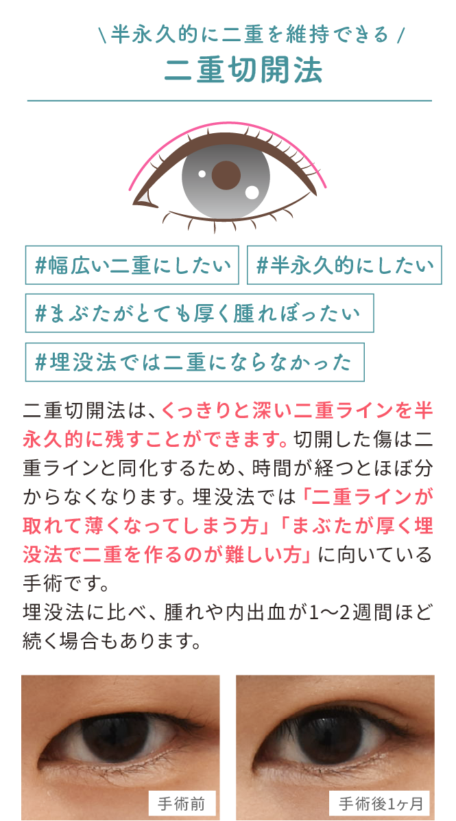 二重切開法